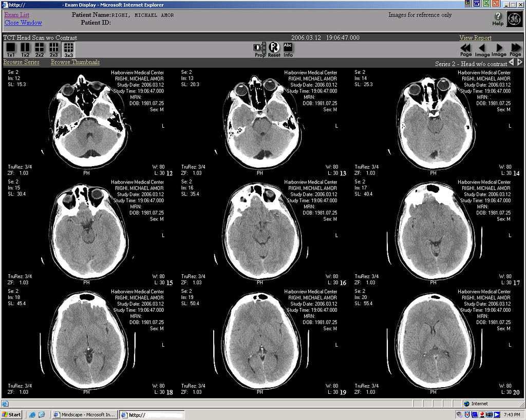 Buscan nuevas formas de diagnosticar la ETC en vida
