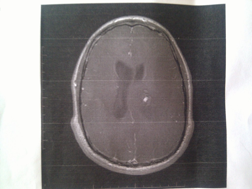 Resonancias detectan señales de Alzheimer años antes