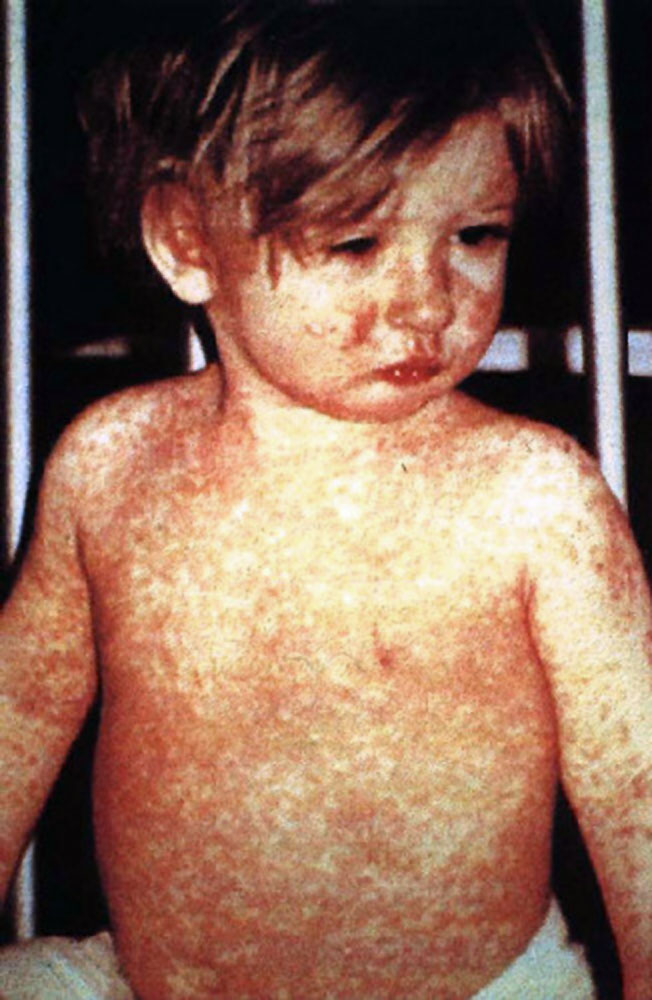 CDC ignoró petición de estados para validar prueba de sarampión